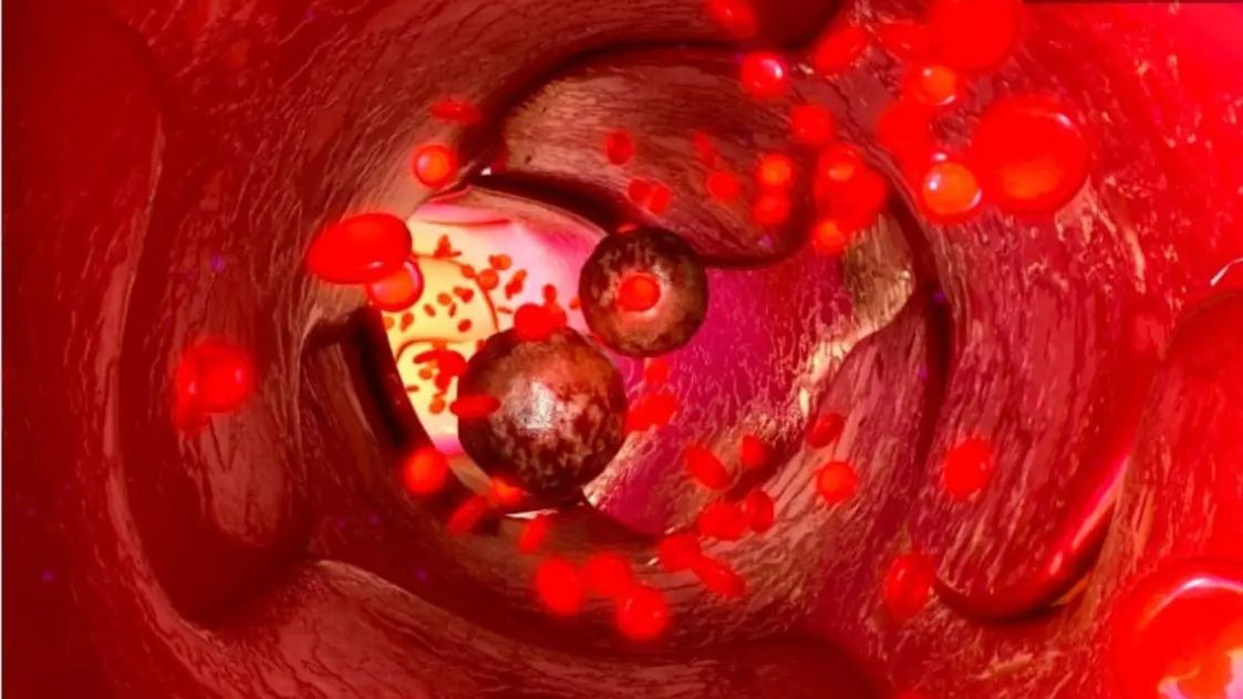 ‘या’ प्रकारचे अन्न खाल्यावर १००% होणार आतड्याचा कॅन्सर, वाचून म्हणाल आम्ही तर रोजच…